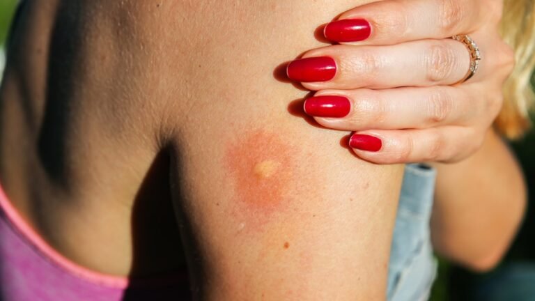 Find out how to Get Rid of Bug Bites Quick (As a result of Scratching Is Not the Reply)